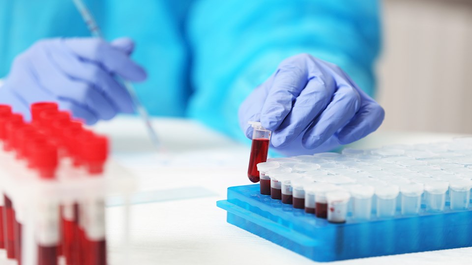Tam Kan Sayımı Testi Nedir? Kan Tahlili Sonuçlarının Anlamları Nelerdir?