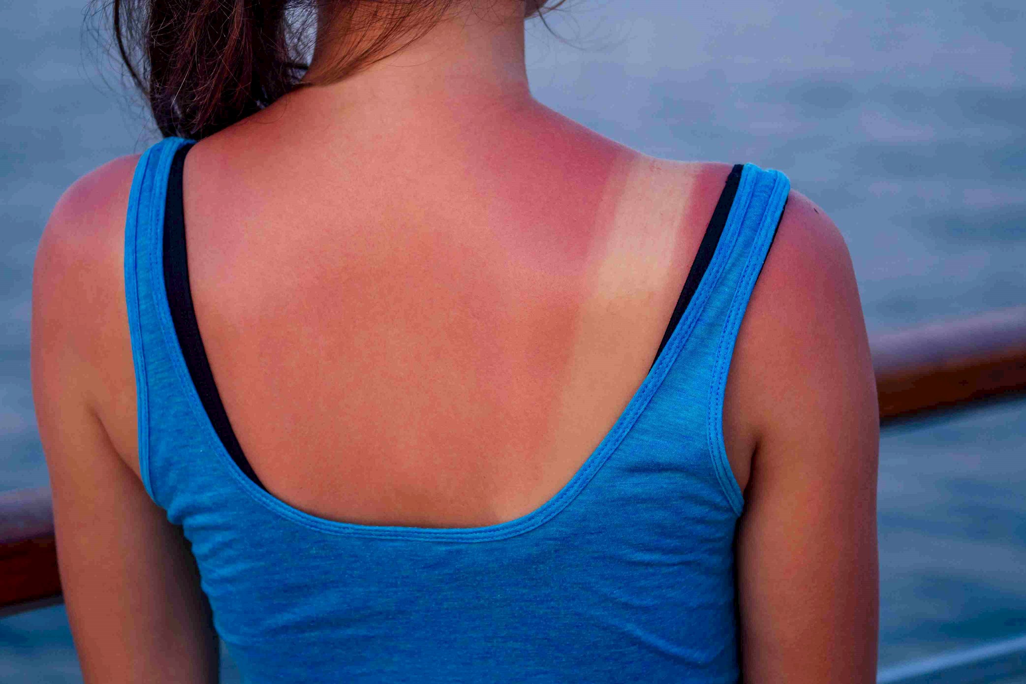Güneş Alerjisi Nedir? Güneş Alerjisi Belirtileri ve Tedavisi