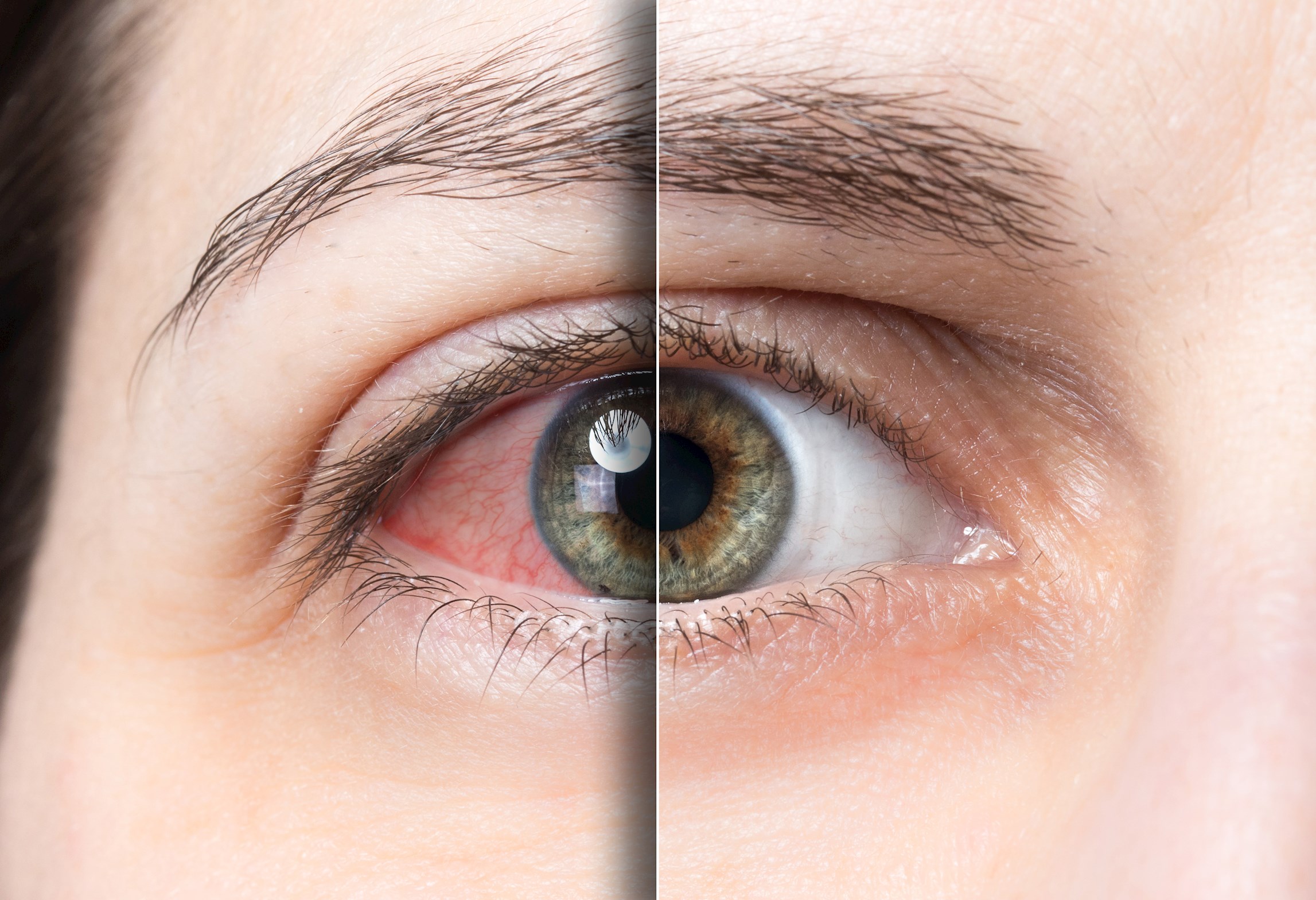 Körlüge götüren sinsi hastalik: Göz tansiyonu